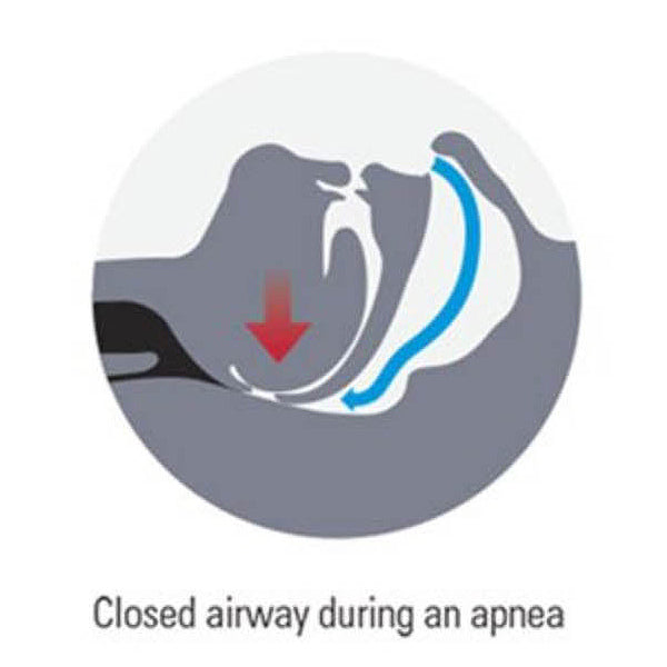 Sleep Apnea: Understanding the Condition and Effective Solutions
